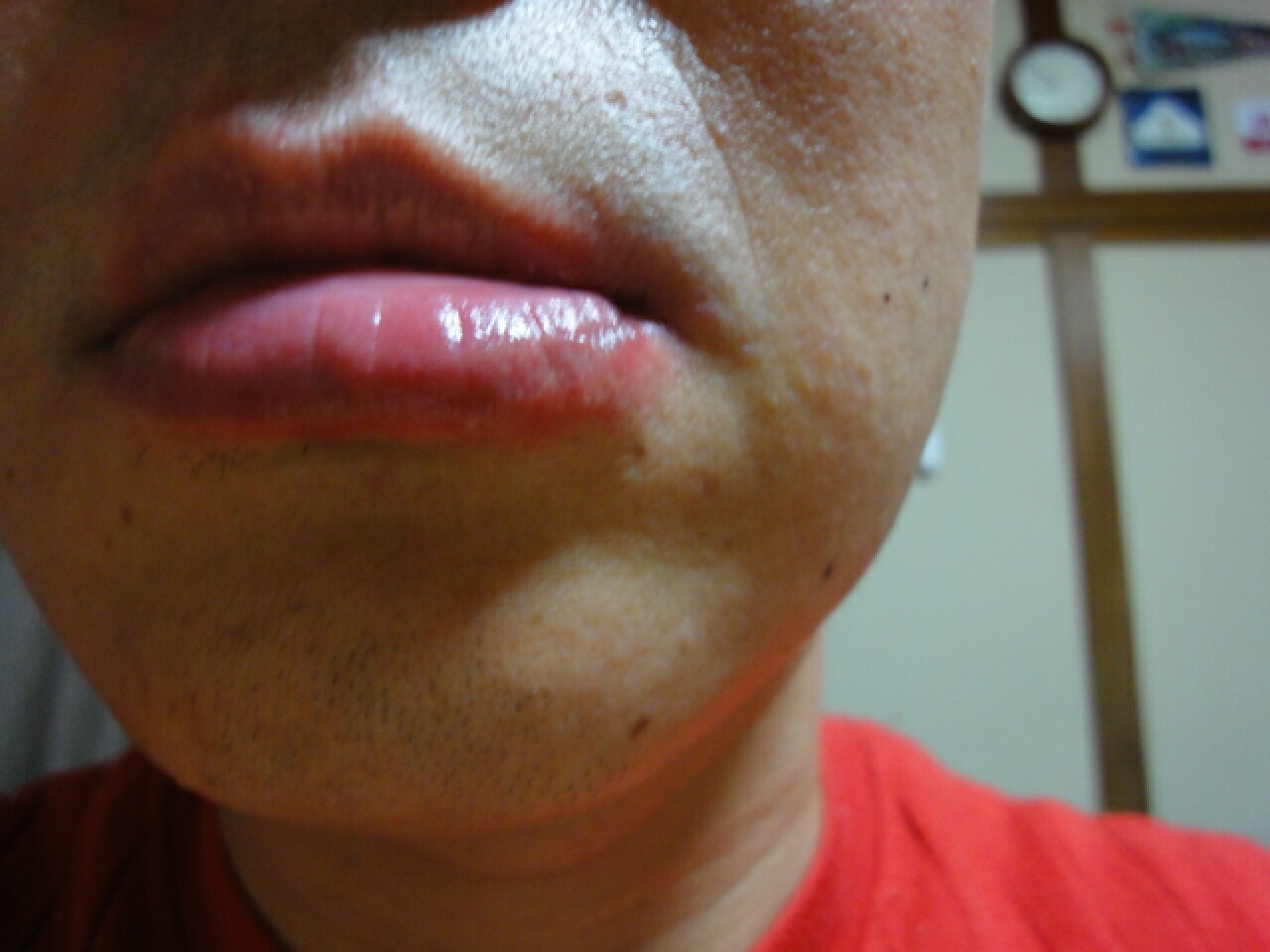 唇 が 腫れる 下 下唇が腫れる8つの原因を徹底解説！効果的な治し方を伝授！